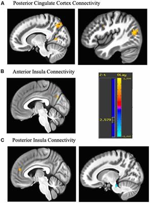 Changes in Functional Connectivity Following Treatment With Emotion Regulation Therapy